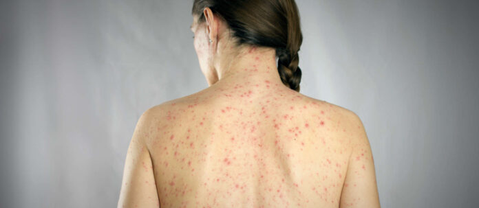 treatment eczemaconcept. girls back skin rashes