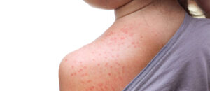 Red rash on baby skin at the back / Roseola infantum / Exant
