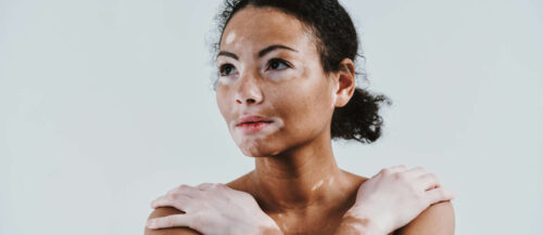 Beautiful woman with vitiligo skin posing in studio. Concept